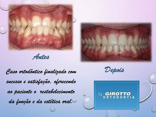 Paciente com crescimento mandibular acentuado (prognata) e severa falta de espaço. O caso foi tratado através da interação entre cirurgia ortognática e ortodontia. 
